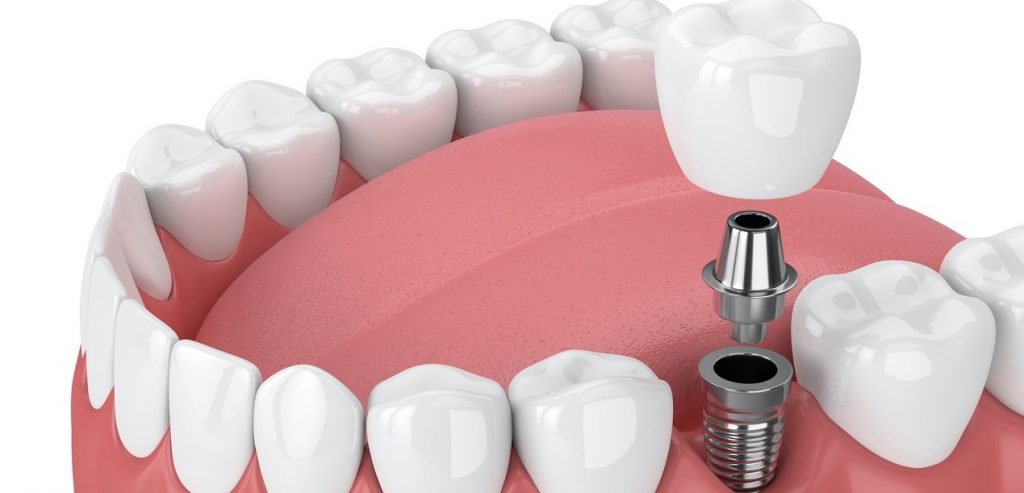 Dental Implants